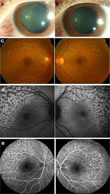 Case Report: Serial changes of ocular complications related to immune checkpoint inhibitors pembrolizumab and nivolumab